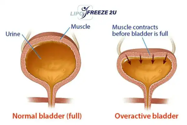diagram of overactive bladder treatment Waltham's Cross