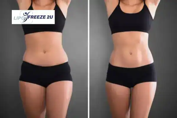 How Can LIPO FREEZE 2U Support Your Post-Pregnancy Body Recovery Waltham's Cross?