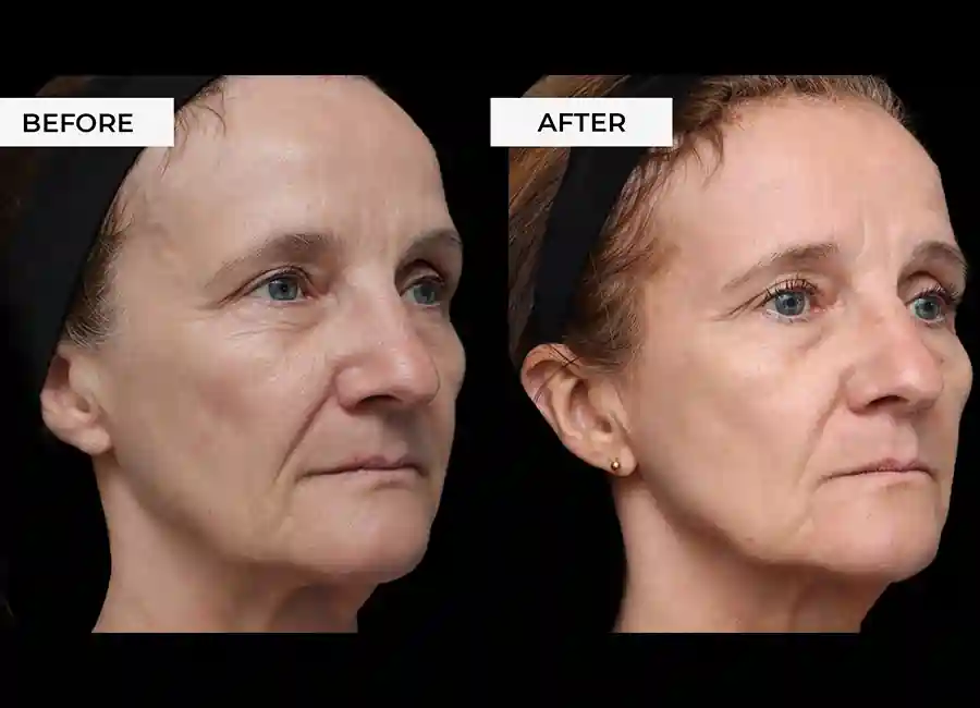 How Many RF Microneedling Sessions Will You Need to See a Difference Waltham's Cross?