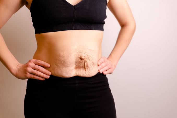 Is Surgery Really the Only Way to Repair Diastasis Recti Waltham's Cross?