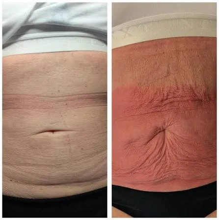 How Does RF Microneedling Improve Crepey, Thin and Uneven Skin Texture Waltham's Cross?