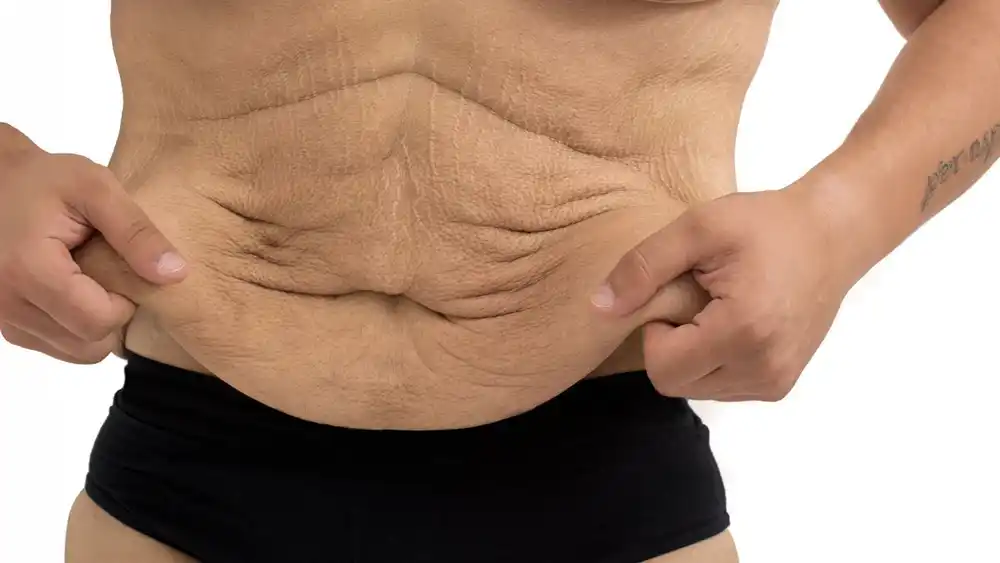 Why Does Weight Loss Medication Leave Some People With Loose or Sagging Skin Waltham's Cross?